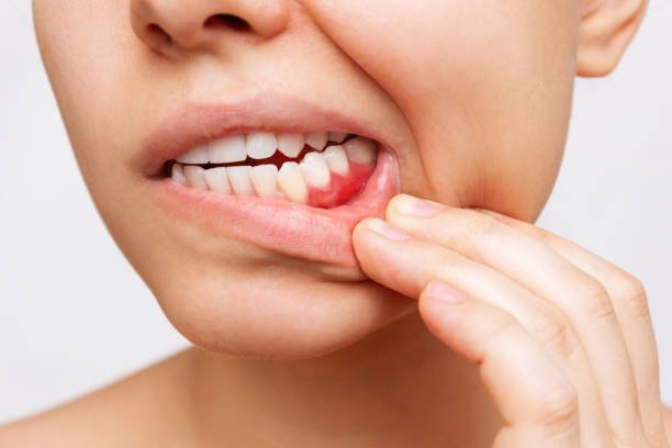 Gums Treatment
