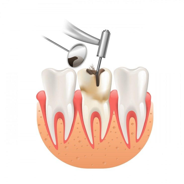 Best Root Canal Treatment in Faridabad