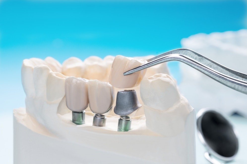 Best Dental Implant in Faridabad