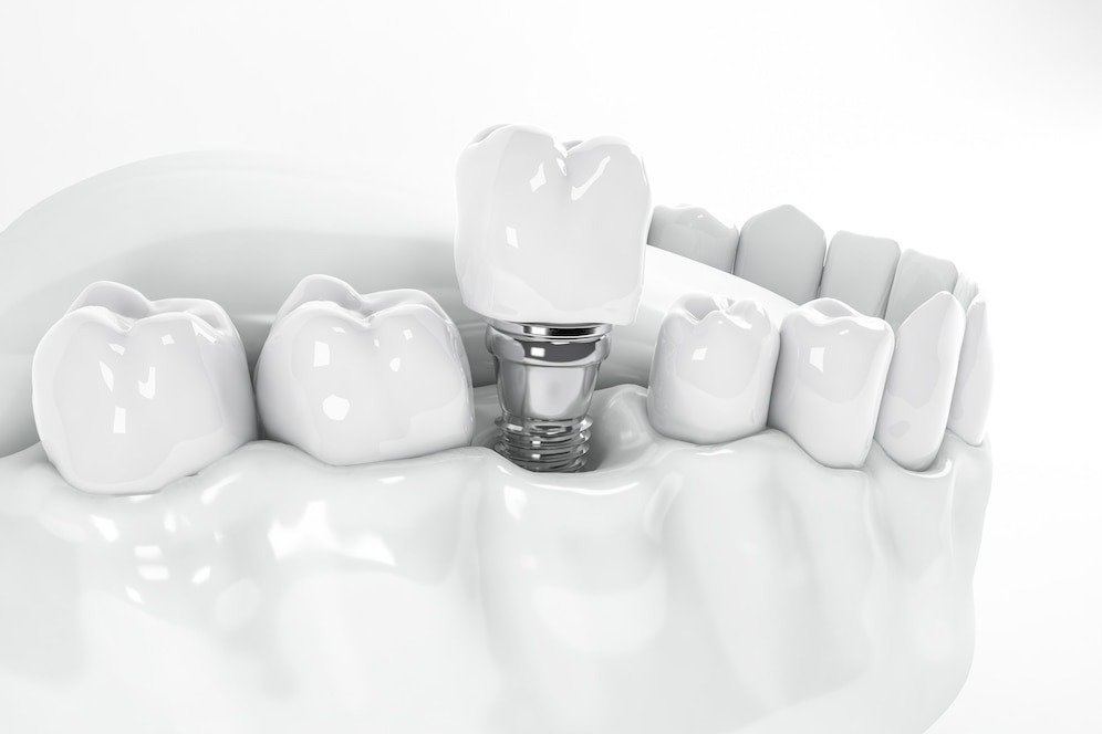 Dental Implant in Faridabad