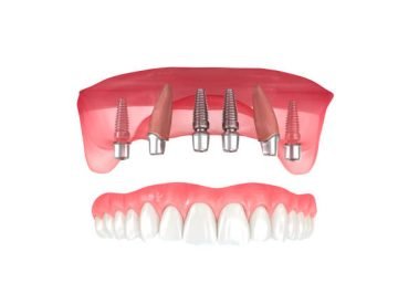 Maxillary prosthesis supported by 2 teeth and 4 implants. Dental 3D illustration