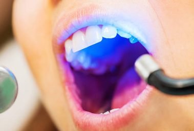 Close-up of female patient having her teeth whitened.