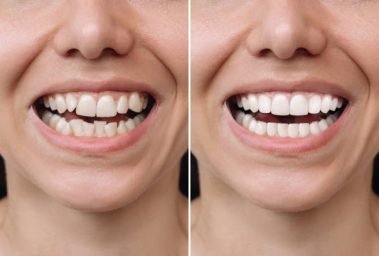 Cropped shot of a young caucasian smiling woman before and after veneers installation. Teeth whitening. Dentistry, dental treatment. Сorrection of uneven teeth with braces