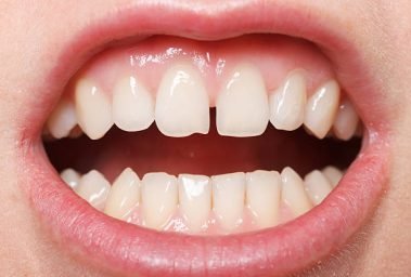 Diastema between the upper incisors is a normal feature