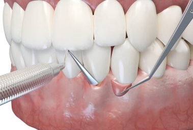Gum Surgery