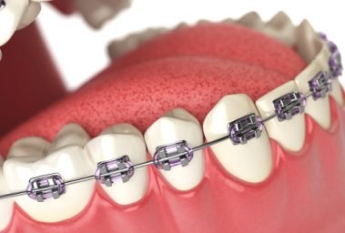 Teeth with braces or brackets in open human mouth. Dental care concept. 3d illustration