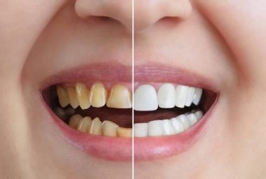 Treatment and whitening of teeth, dental crowns. Before and after. Dentistry. Close-up.