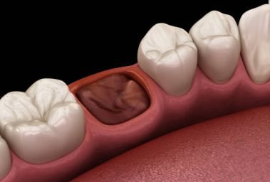 The blood clot seals off the tooth after extraction. Medically accurate 3D illustration