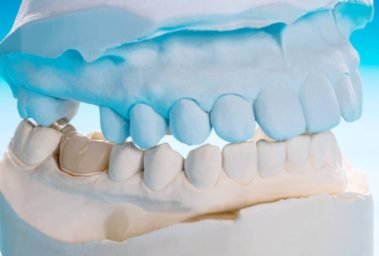 Closeup / Prosthodontics or Prosthetic / Single teeth crown and bridge equipment model express fix restoration.