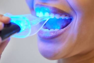 The fastest and safest approach to teeth whitening